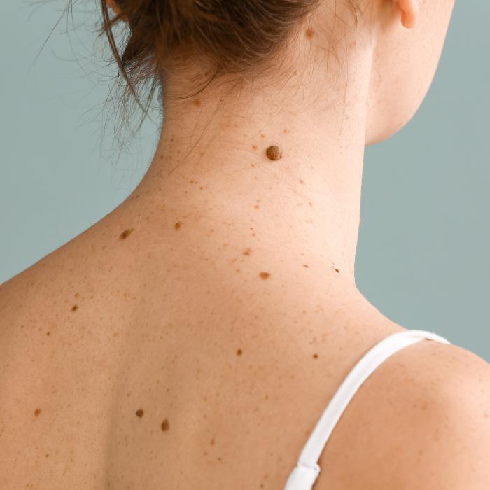 Konsultacje dermatologiczne z dermatoskopią Katowice Konsultacje dermatologiczne z dermatoskopią Katowice